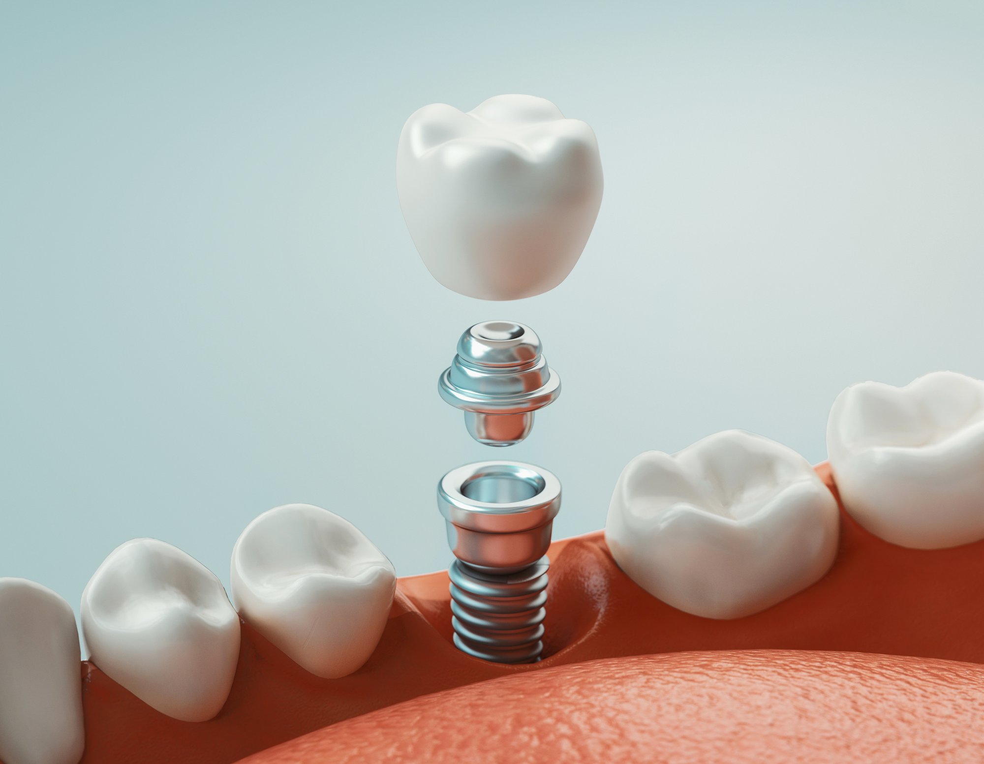 Will I Ever Need to Replace My Implant?